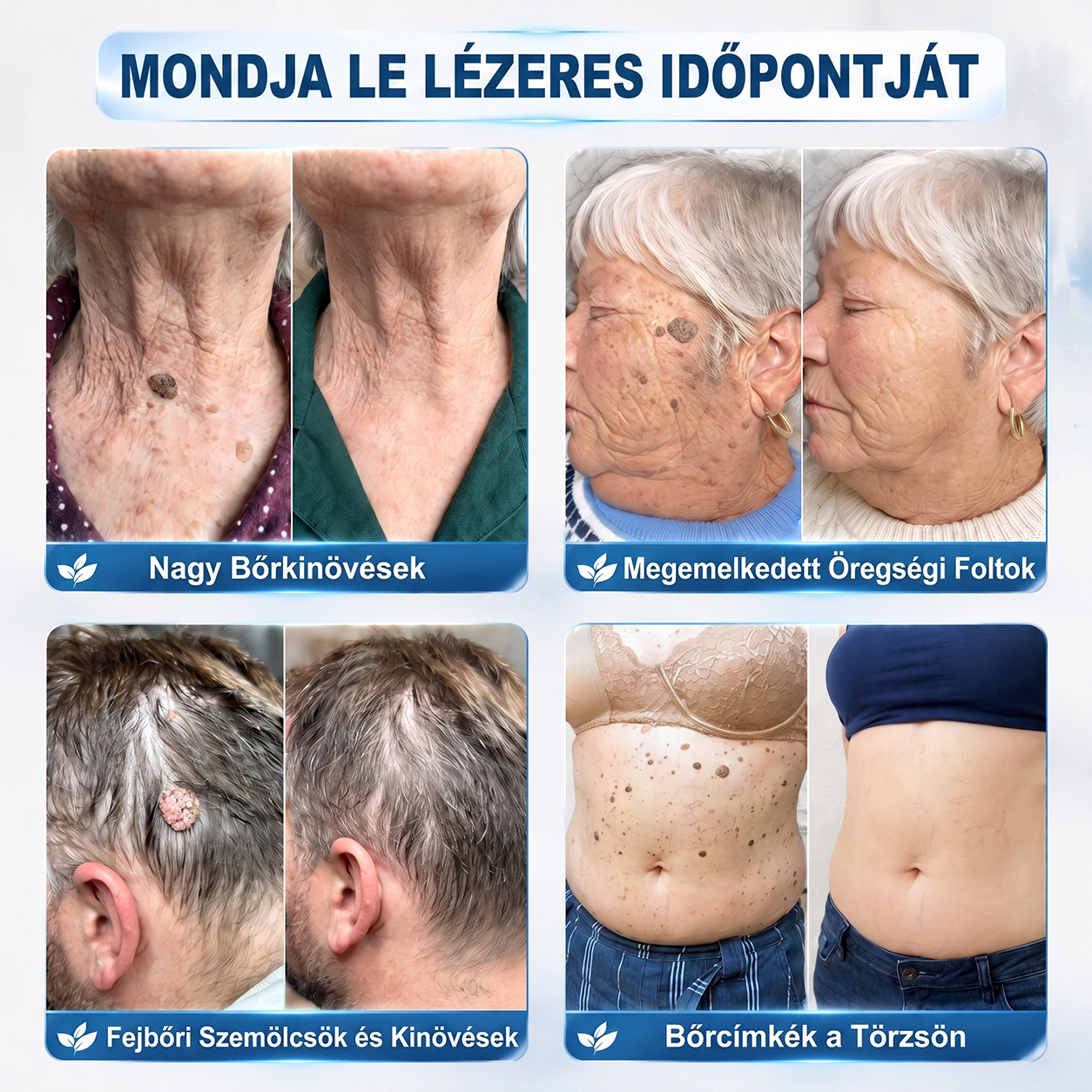 👑Hivatalos Márkabolt | 🚢🚢 Hiskin® 7 napos Szemölcseltávolító Roll-on Ápoló Folyadék (Fájdalommentes rollerball technológia, hegek nélkül) 🐬