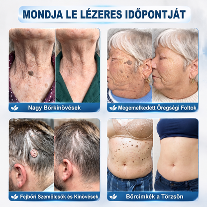 👑Hivatalos Márkabolt | 🚢🚢 Hiskin® 7 napos Szemölcseltávolító Roll-on Ápoló Folyadék (Fájdalommentes rollerball technológia, hegek nélkül) 🐬