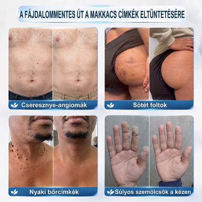 👑Hivatalos Márkabolt | 🚢🚢 Hiskin® 7 napos Szemölcseltávolító Roll-on Ápoló Folyadék (Fájdalommentes rollerball technológia, hegek nélkül) 🐬