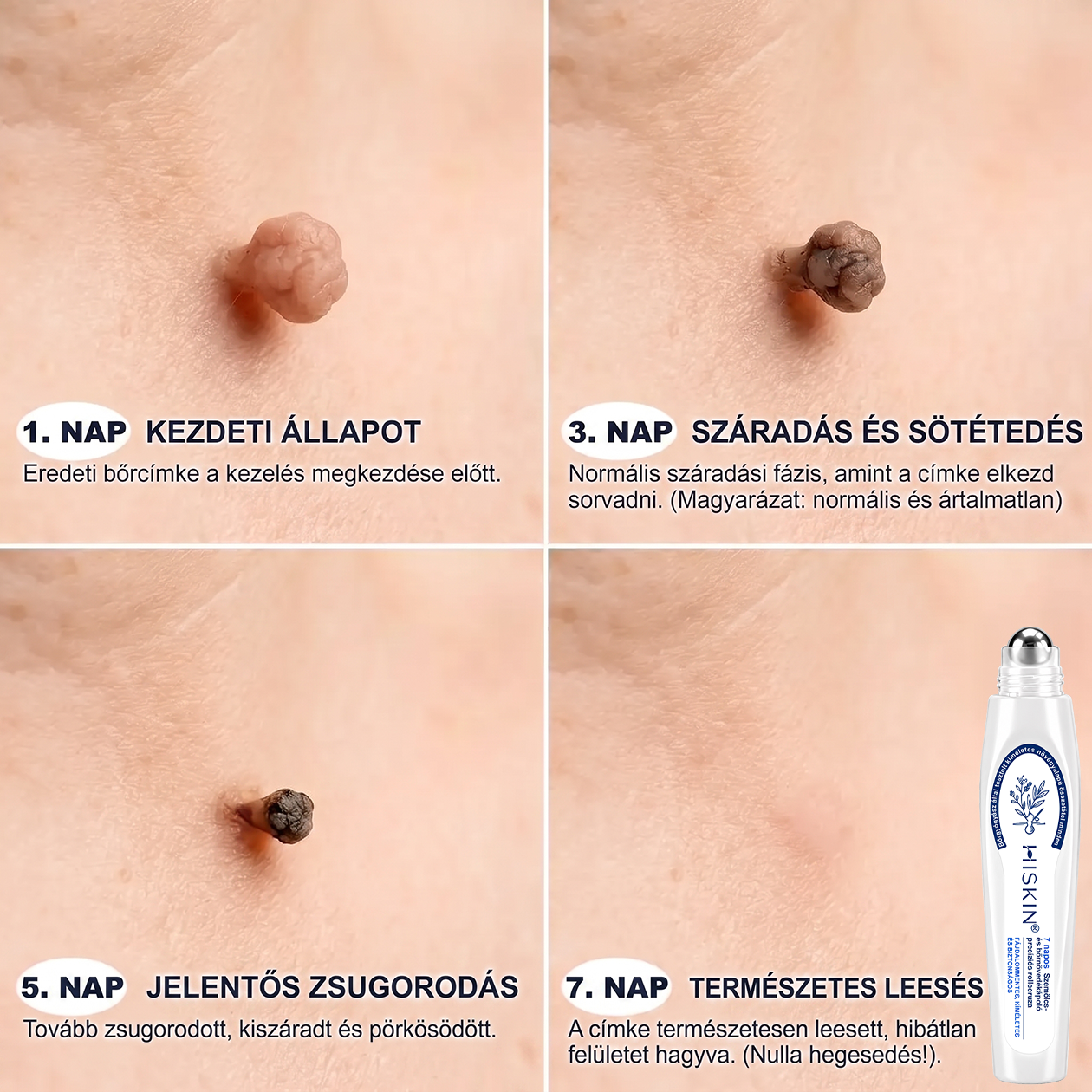 👑Hivatalos Márkabolt | 🚢🚢 Hiskin® 7 napos Szemölcseltávolító Roll-on Ápoló Folyadék (Fájdalommentes rollerball technológia, hegek nélkül) 🐬