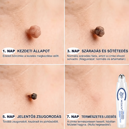 👑Hivatalos Márkabolt | 🚢🚢 Hiskin® 7 napos Szemölcseltávolító Roll-on Ápoló Folyadék (Fájdalommentes rollerball technológia, hegek nélkül) 🐬