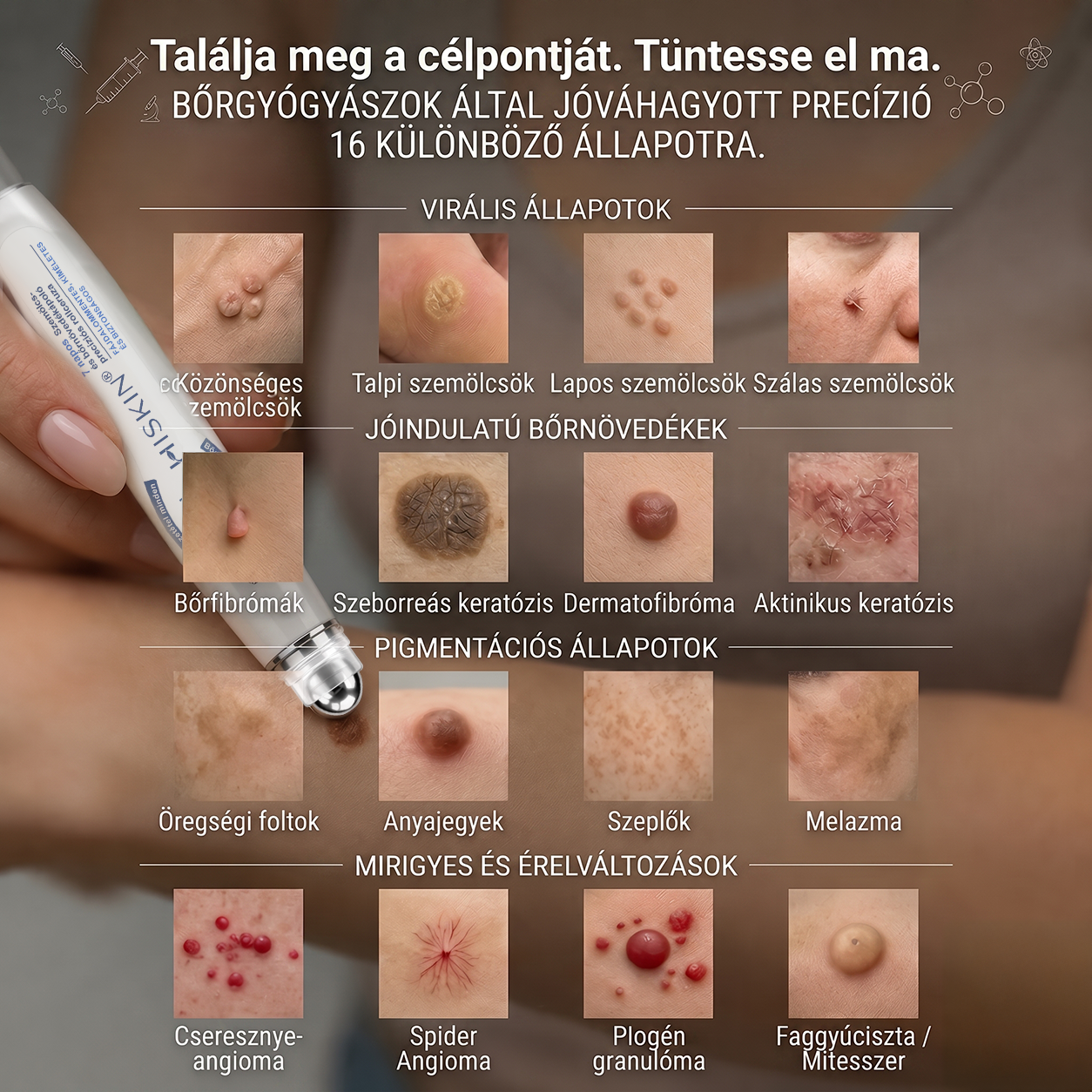👑Hivatalos Márkabolt | 🚢🚢 Hiskin® 7 napos Szemölcseltávolító Roll-on Ápoló Folyadék (Fájdalommentes rollerball technológia, hegek nélkül) 🐬